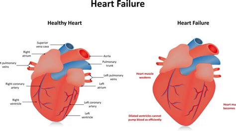 global hypokinesia of lv in hindi|hypokinesis pubmed.